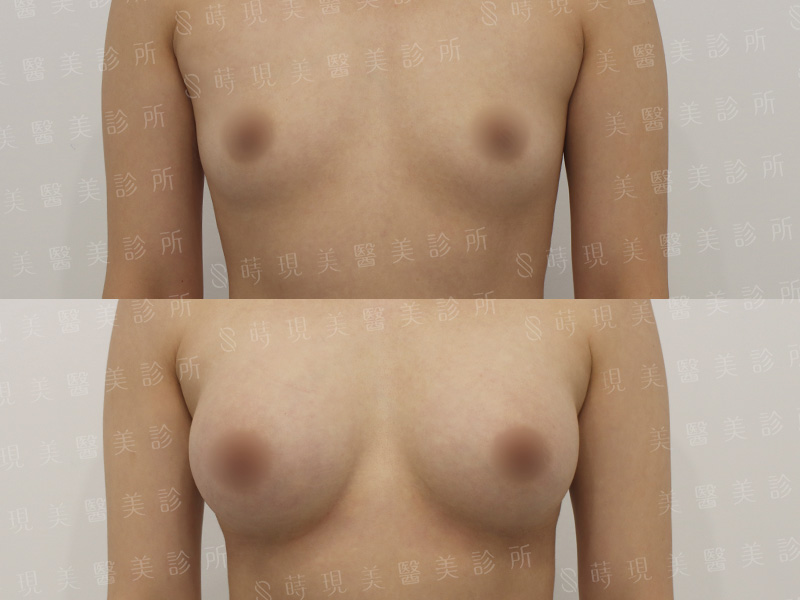 脂感隆乳 (複合式隆乳)