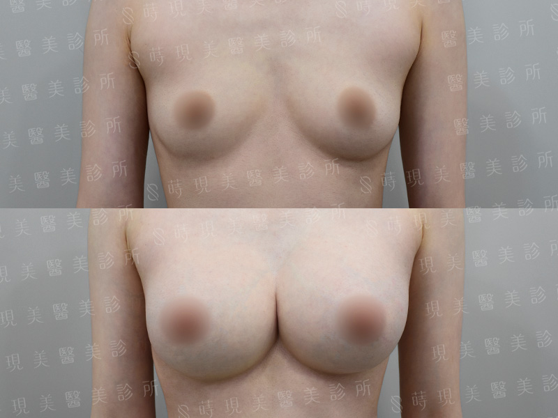 脂感隆乳 (複合式隆乳)