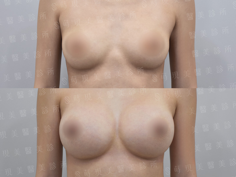 脂感隆乳 (複合式隆乳)