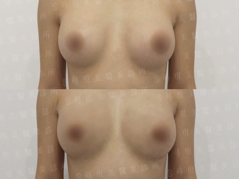 抽脂補胸＋PRP