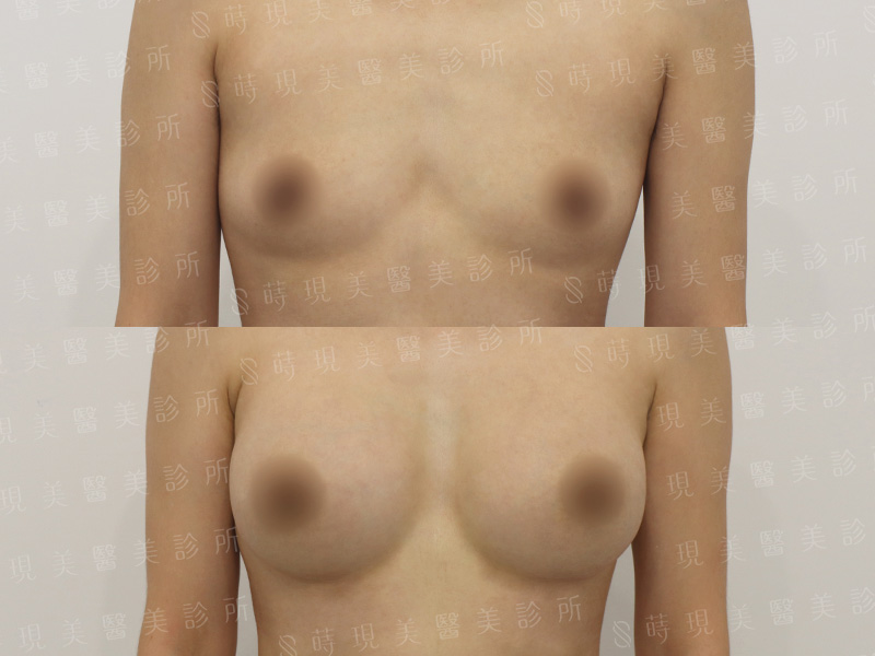 脂感隆乳 (複合式隆乳)