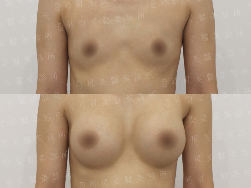 脂感隆乳 (複合式隆乳)