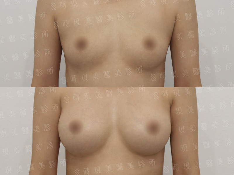 脂感隆乳 (複合式隆乳)