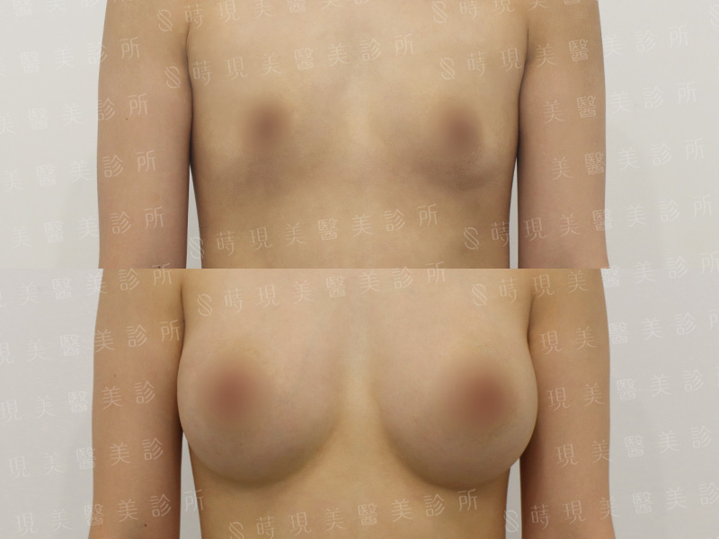 脂感隆乳 (複合式隆乳)