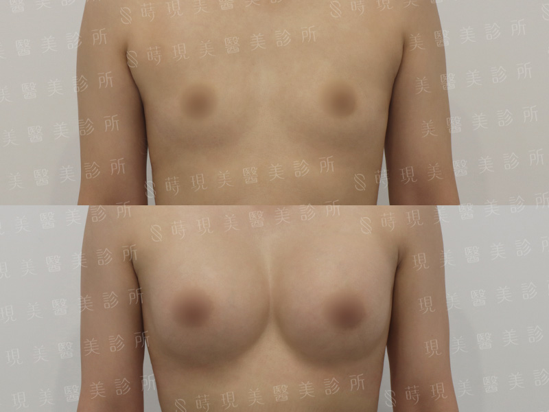 脂感隆乳 (複合式隆乳)