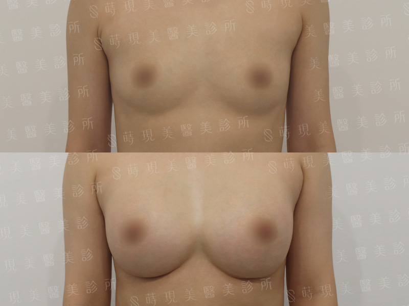 脂感隆乳 (複合式隆乳)