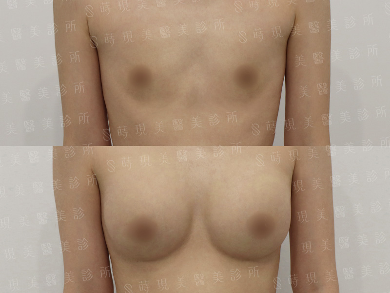 脂感隆乳 (複合式隆乳)