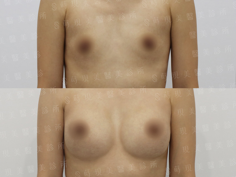 脂感隆乳 (複合式隆乳)