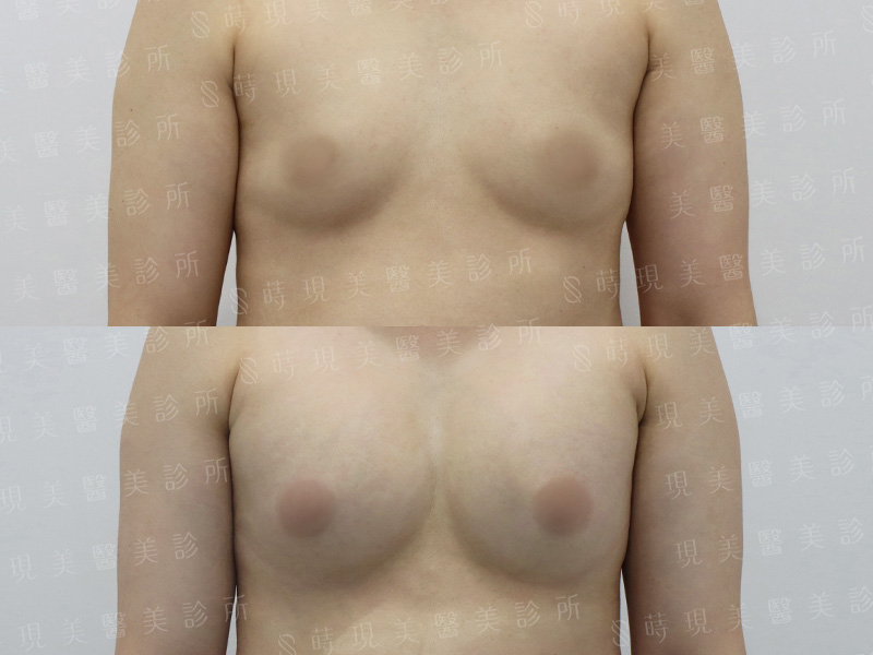 脂感隆乳 (複合式隆乳)