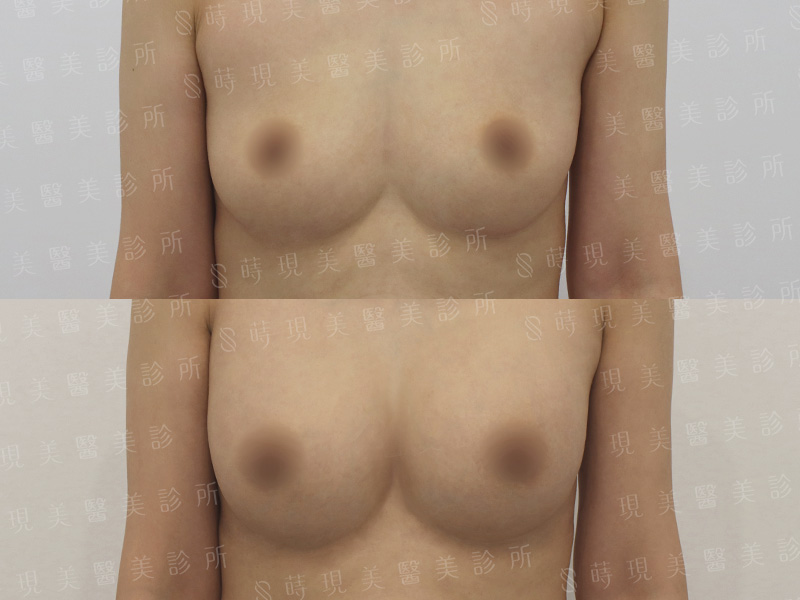 脂感隆乳 (複合式隆乳)