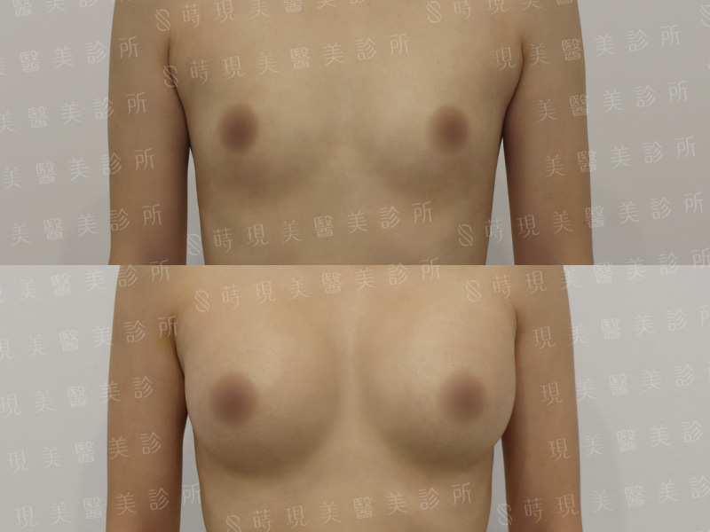 脂感隆乳 (複合式隆乳)