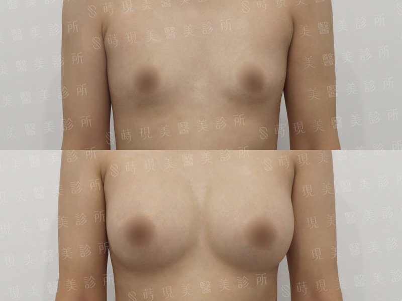 脂感隆乳 (複合式隆乳)