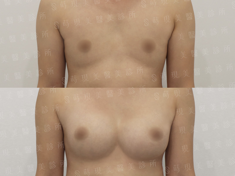 脂感隆乳 (複合式隆乳)＋縮乳頭