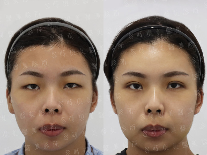 縫雙眼皮＋取脂