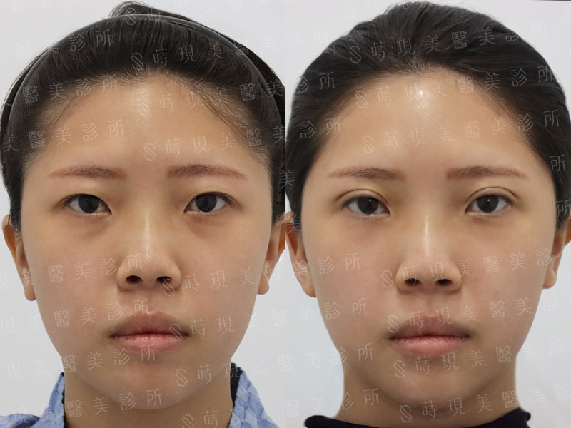 縫雙眼皮＋取脂
