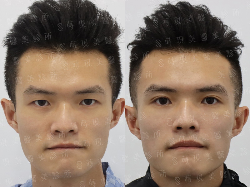 縫雙眼皮＋皮秒蜂巢