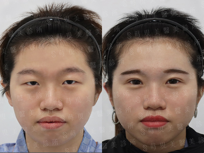 割雙眼皮＋提眼瞼肌