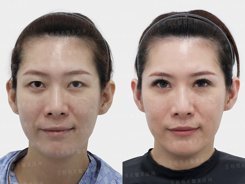 割雙眼皮＋提眼瞼肌