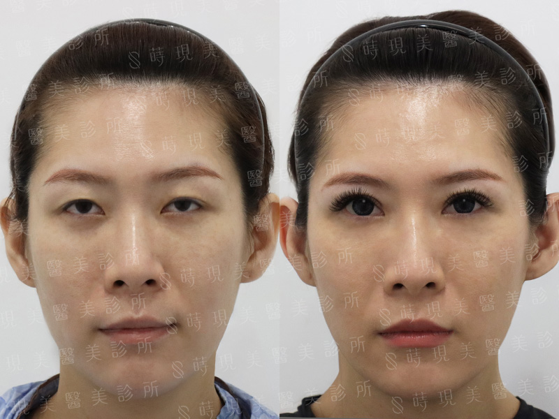 割雙眼皮＋提眼瞼肌