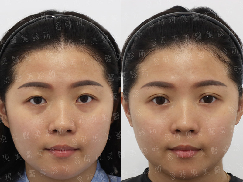縫雙眼皮＋取脂