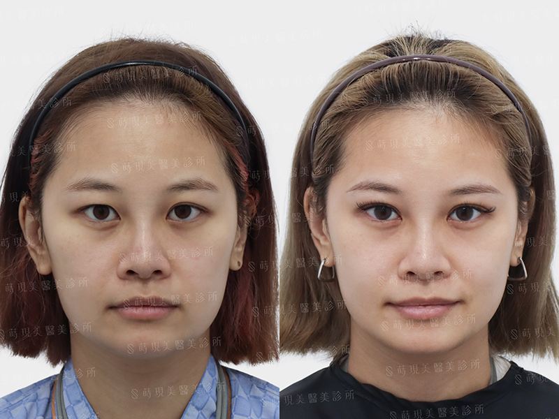 縫雙眼皮＋取脂