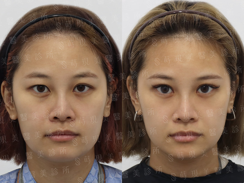 縫雙眼皮＋取脂