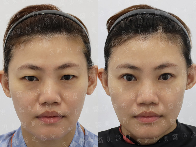 縫雙眼皮＋取脂＋內視鏡拉皮