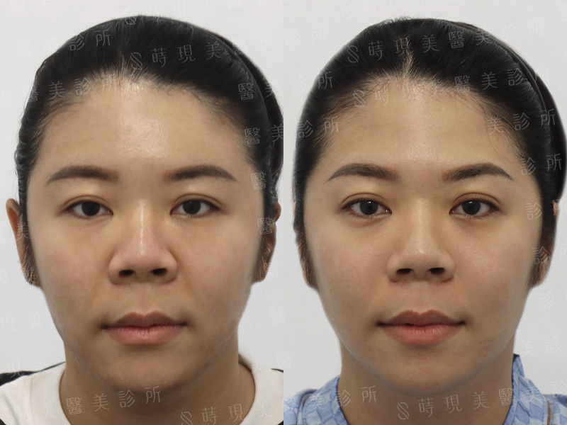 提眉＋全臉補脂＋貓咪紋＋鳳凰電波＋肉毒桿菌