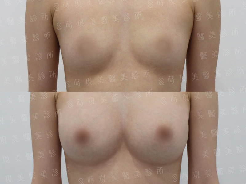 脂感隆乳 (複合式隆乳)