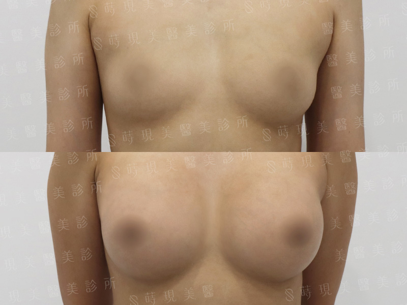 脂感隆乳 (複合式隆乳)