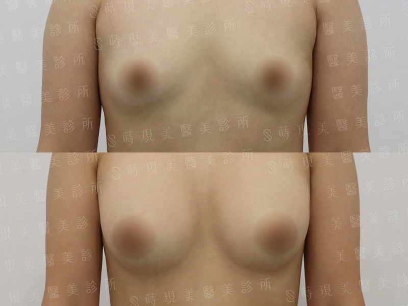 脂感隆乳 (複合式隆乳)