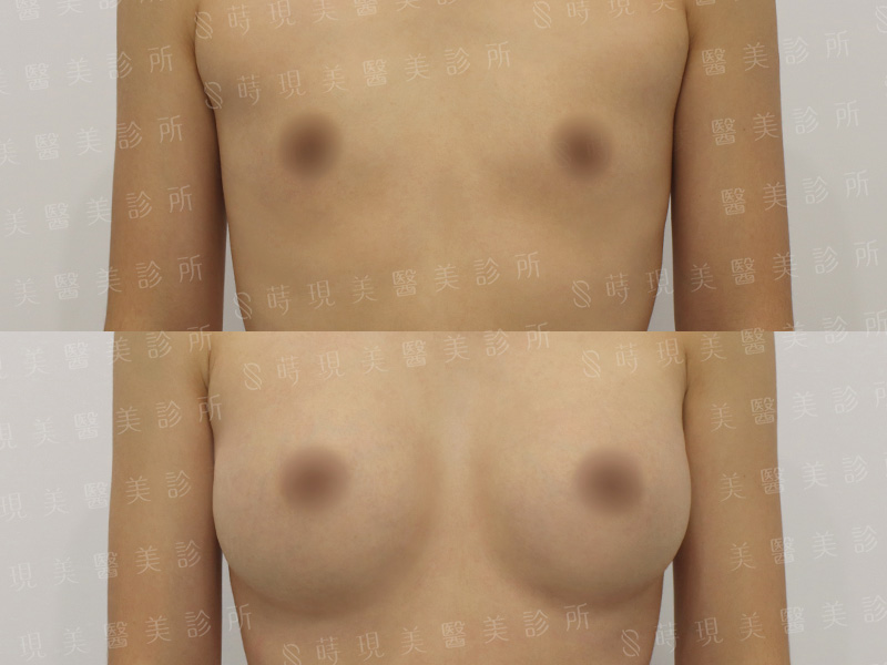 脂感隆乳 (複合式隆乳)＋縮乳頭