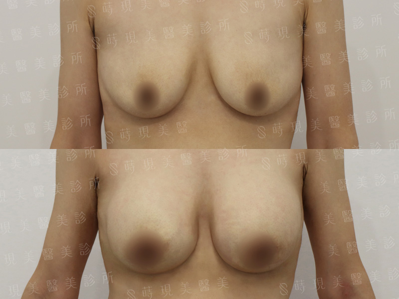 脂感隆乳 (複合式隆乳)