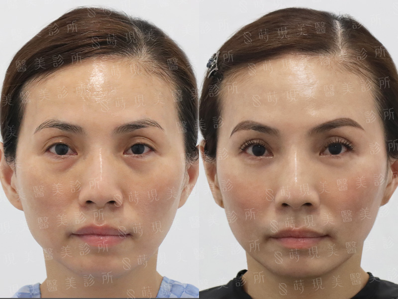 眼袋移位＋蘋果肌補脂＋肉毒魚尾紋