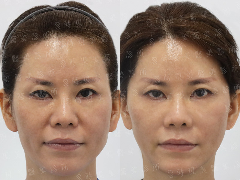 VsorbB 蛇牙線＋法令紋玻尿酸