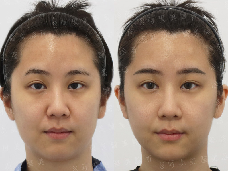 鳳凰電波＋音波＋玻尿酸輪廓線＋肉毒小臉