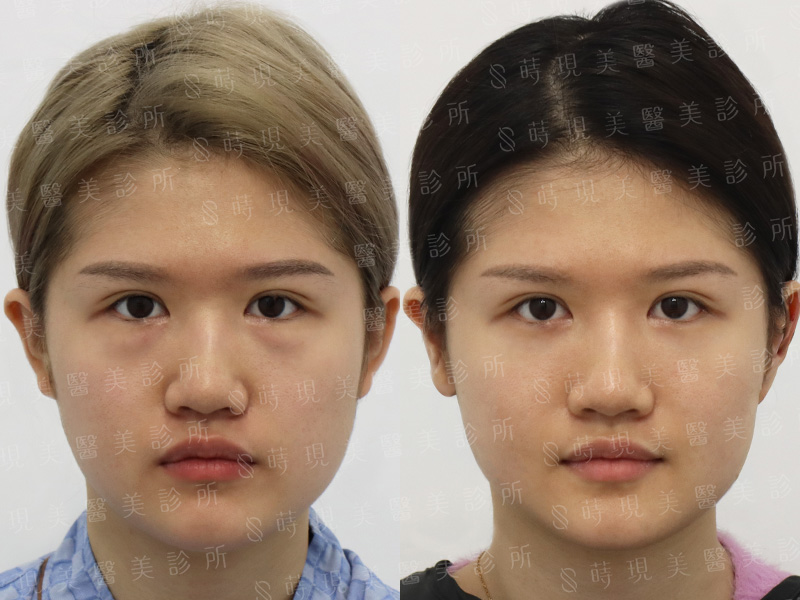 眼袋移位＋蘋果肌補脂