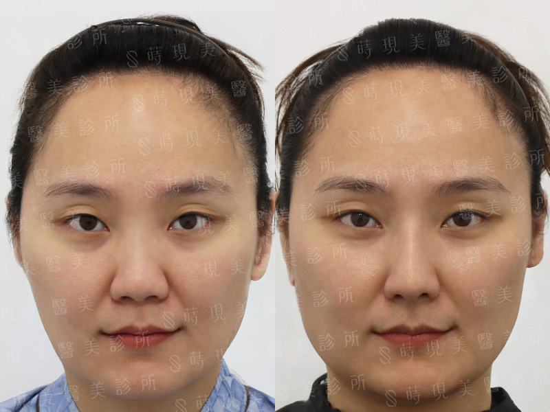 三段式異肋隆鼻