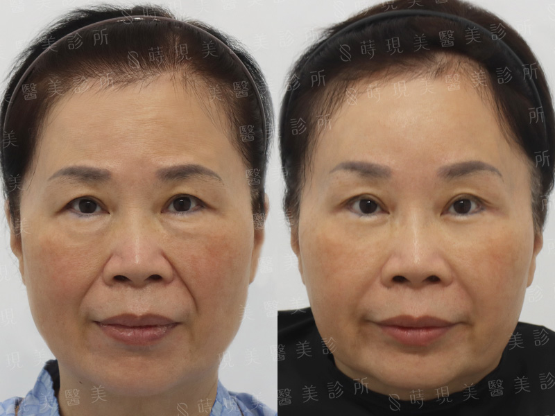 眼袋移位＋蘋果肌補脂＋肉毒全臉