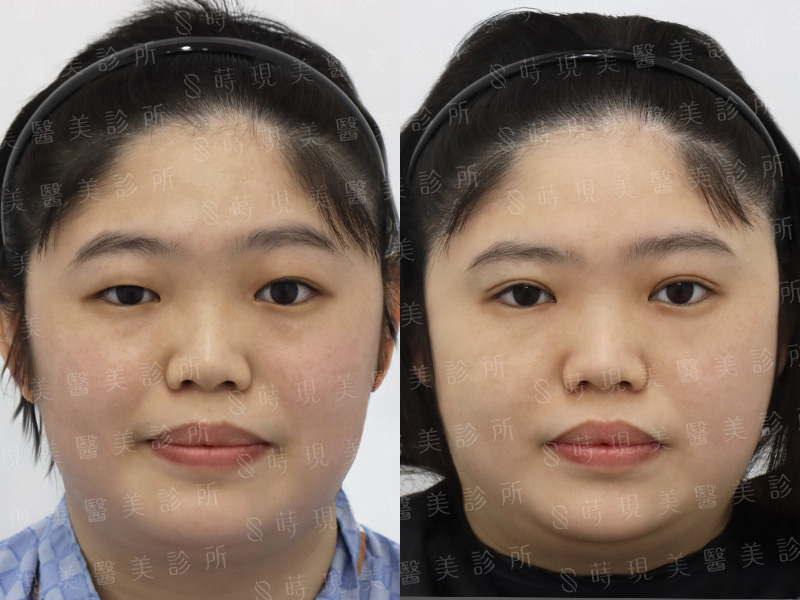 縫雙眼皮＋取脂