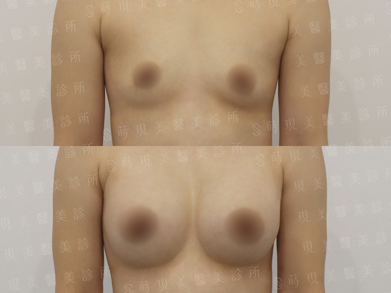 脂感隆乳 (複合式隆乳)