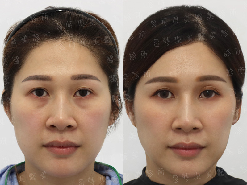 眼袋移位＋全臉補脂