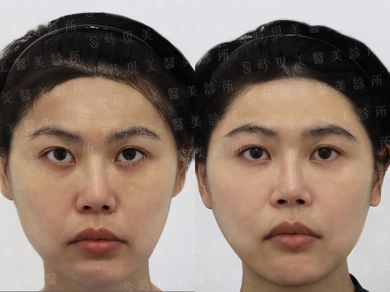 鳳凰電波＋取下巴假體補脂＋蘋果肌補脂