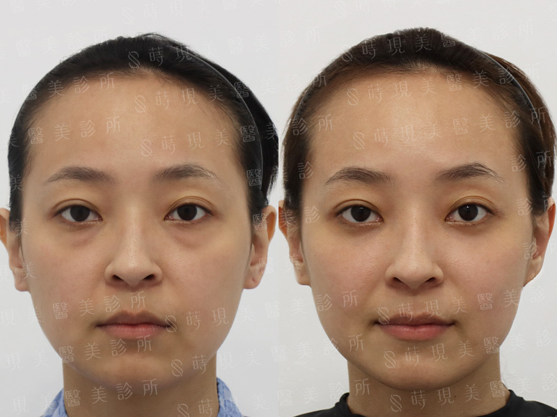 眼袋移位＋肉毒魚尾＋臉部補脂