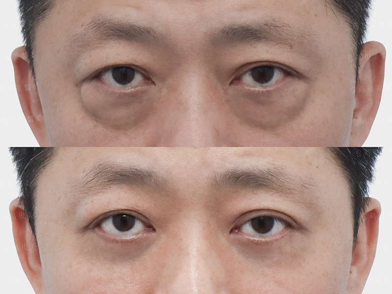 眼袋移位外修皮＋眼下飛梭＋肉毒魚尾