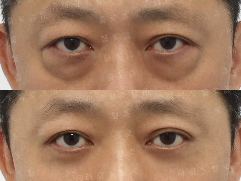 眼袋移位外修皮＋眼下飛梭＋肉毒魚尾