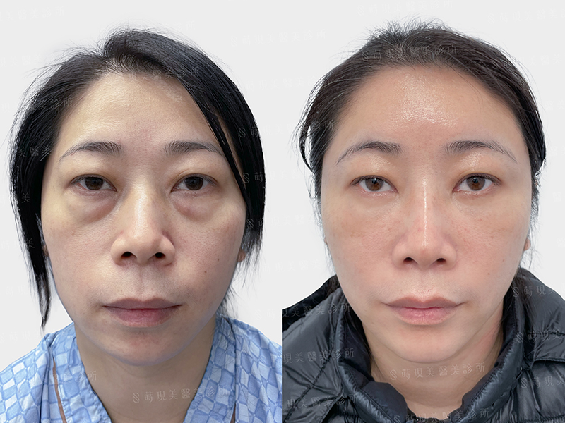 眼袋移位＋全臉補脂