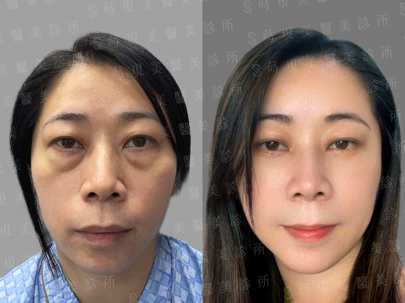 眼袋移位＋全臉補脂