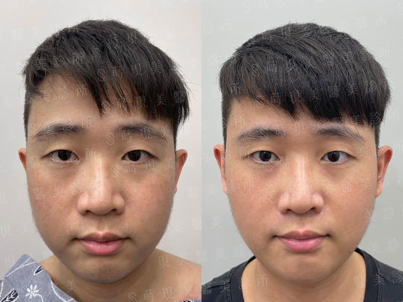 下巴抽脂＋口內取脂