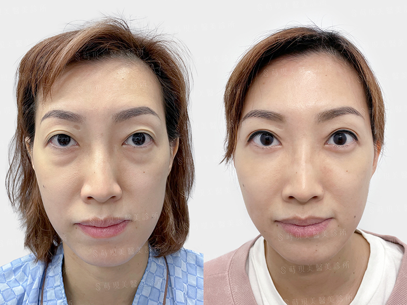 縫雙眼皮＋眼袋移位＋蘋果肌補脂